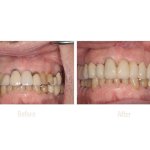 Before Treatment and After Smile Makeover