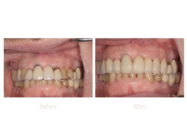 Before Treatment and After Smile Makeover