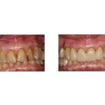 Before and After