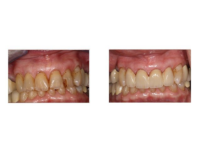 Before and After