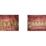 Before and After