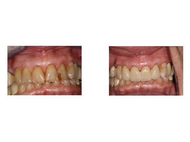 Before and After