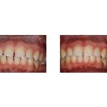 Before and After Treated with Invisalign to Close Spaces