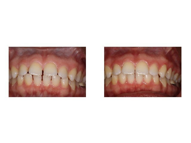 Before and After Treated with Invisalign to Close Spaces