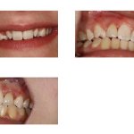 Before and After Ceramic Restoration for Misaligned Teeth