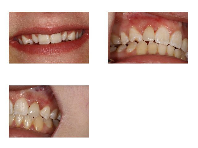 Before and After Ceramic Restoration for Misaligned Teeth