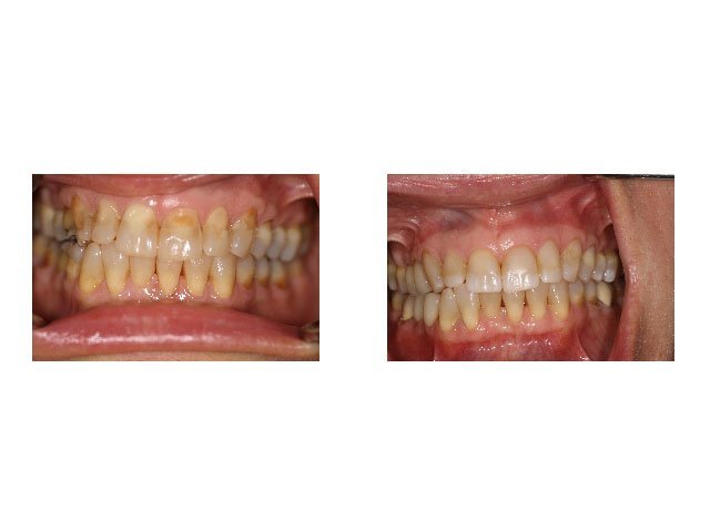 Before and After Treatment of Eroded and Discolored Teeth with Bonded Restoration and Crowns