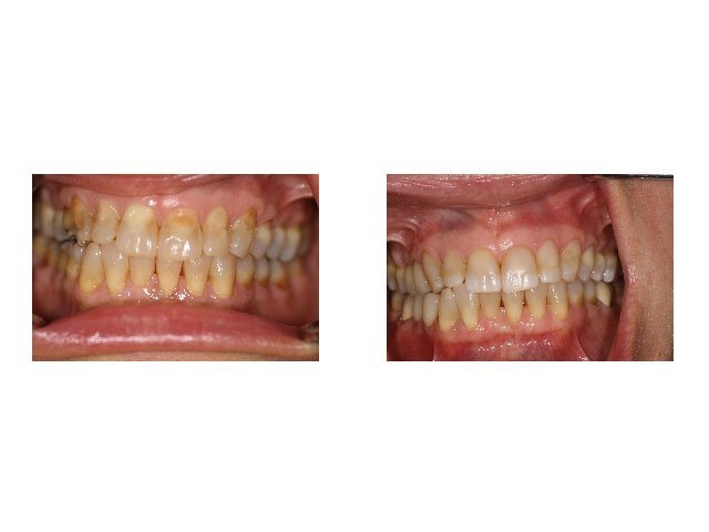 Before and After Treatment of Eroded and Discolored Teeth with Bonded Restoration and Crowns