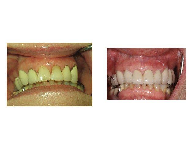 Before and After Restoring with Crowns and Removable Bridge