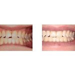 Before and After Treatment with Bonded Restoration