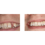 Before and After