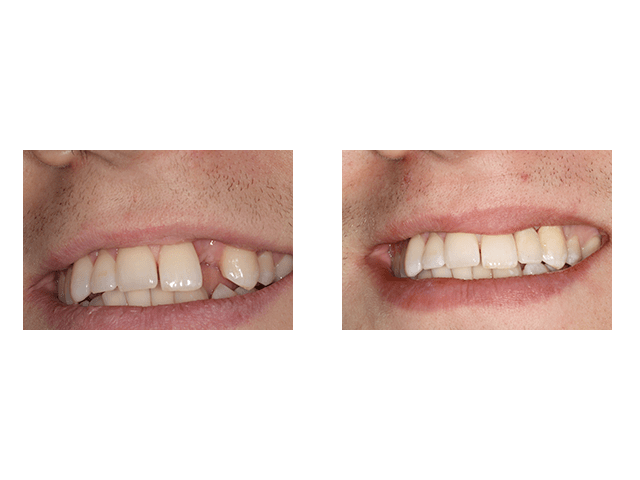 Before and After