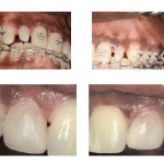 Before and After Restoration of Misshaped Teeth with Bonded Restoration After Orthodontic Treatment