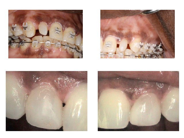 Before and After Restoration of Misshaped Teeth with Bonded Restoration After Orthodontic Treatment