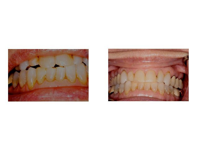 Before and After Treatment with Invisalign and Bonded Restoration