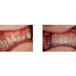 Before and After Treatment with Invisalign