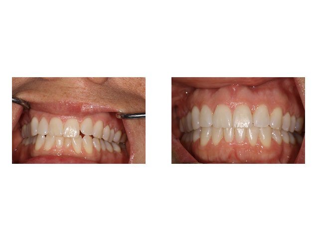 Invisalign Before and After