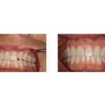 Before and After Dental Treatment