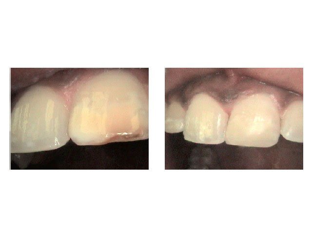 Restoration with Bonded Filling to a Discolored/Decayed Tooth