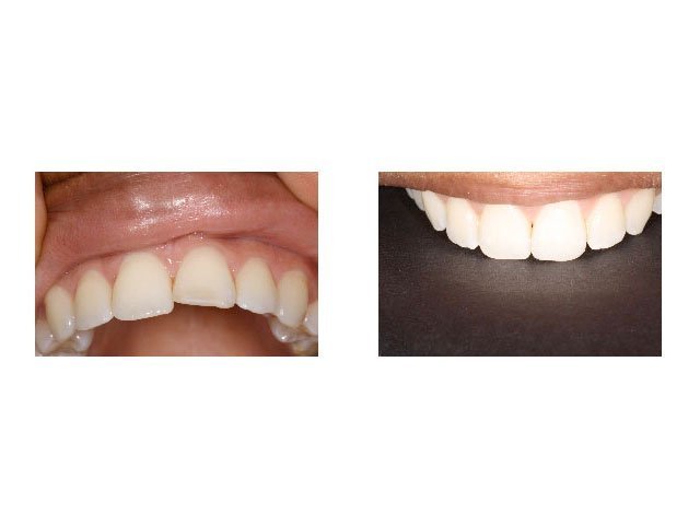 Before and After Restoring Misaligned Tooth with Bonded Restoration