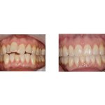 Before and After Treatment with Invisalign