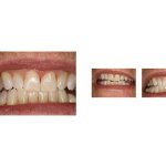 Dr. Tekle, Before and After photo of straightened teeth