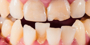 Invisalign can be an option for correcting crooked teeth